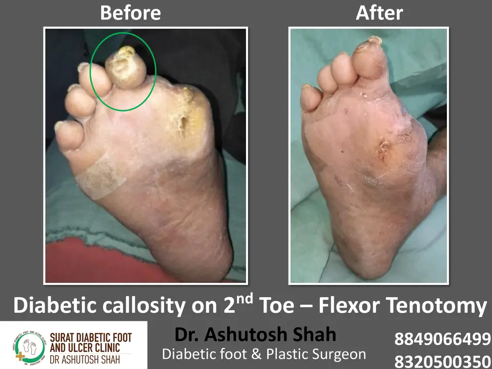 Diabetic Foot  PPT sunita.pptx-42.webp